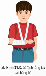 1. SƠ CỨU, BĂNG BÓ GÃY XƯƠNG- Dụng cụ: băng y tế, mỗi cuộn dài 2 m; nẹp gỗ dài khoảng 40 cm, dày khoảng 0,5 – 1 cm; vải sạch, kích thước 20 x 40 cm; gạc y tế. - Tiến hành: Học sinh thực hiện các bước sơ cứu, băng bó trên mô hình hoặc làm mẫu. + Bước 1: Đặt nẹp gỗ đỡ lấy cẳng tay (có thể sử dụng một hoặc hai nẹp tuỳ vào diều kiện và mức độ xương gãy), đồng thời lót gạc y tế hay vải sạch (dày) ở chỗ các đầu xương (dưới khuỷu tay và cổ tay).+ Bước 2: Sử dụng gạc y tế hoặc vải sạch để buộc cố định nẹp vào tay (Hình 31.1).+ Bước 3: Đặt cuộn băng y tế từ khuỷu tay, sau đó cuốn dẫn ra phía cổ tay (Hình 31.2). Sau khi cuốn băng xong, buộc cố định đầu cuộn băng lại dễ tránh bị lỏng, tuột. + Bước 4: Làm dây đeo vào cổ để cố định cẳng tay sau khi băng bỏ (Hình 31.3).2. ĐIỀU TRA TÌNH HÌNH MẮC CÁC BỆNH VỀ HỆ VẬN ĐỘNG TRONG TRƯỜNG HỌC VÀ KHU DÂN CƯ