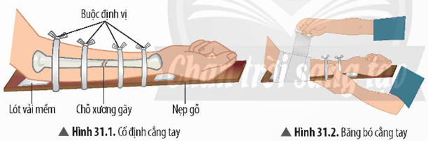 1. SƠ CỨU, BĂNG BÓ GÃY XƯƠNG- Dụng cụ: băng y tế, mỗi cuộn dài 2 m; nẹp gỗ dài khoảng 40 cm, dày khoảng 0,5 – 1 cm; vải sạch, kích thước 20 x 40 cm; gạc y tế. - Tiến hành: Học sinh thực hiện các bước sơ cứu, băng bó trên mô hình hoặc làm mẫu. + Bước 1: Đặt nẹp gỗ đỡ lấy cẳng tay (có thể sử dụng một hoặc hai nẹp tuỳ vào diều kiện và mức độ xương gãy), đồng thời lót gạc y tế hay vải sạch (dày) ở chỗ các đầu xương (dưới khuỷu tay và cổ tay).+ Bước 2: Sử dụng gạc y tế hoặc vải sạch để buộc cố định nẹp vào tay (Hình 31.1).+ Bước 3: Đặt cuộn băng y tế từ khuỷu tay, sau đó cuốn dẫn ra phía cổ tay (Hình 31.2). Sau khi cuốn băng xong, buộc cố định đầu cuộn băng lại dễ tránh bị lỏng, tuột. + Bước 4: Làm dây đeo vào cổ để cố định cẳng tay sau khi băng bỏ (Hình 31.3).2. ĐIỀU TRA TÌNH HÌNH MẮC CÁC BỆNH VỀ HỆ VẬN ĐỘNG TRONG TRƯỜNG HỌC VÀ KHU DÂN CƯ